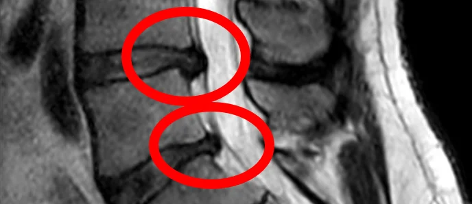 An X-ray image with two points encircled in red.