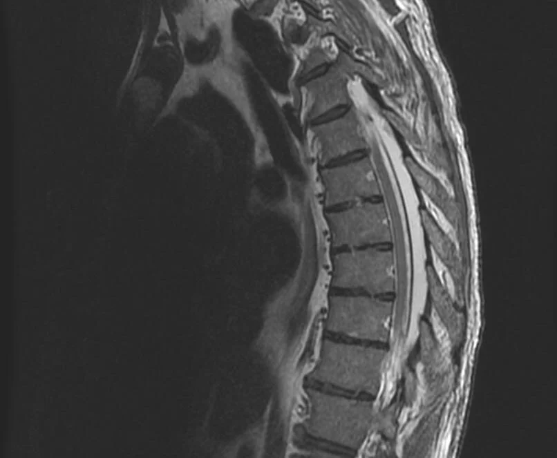 An X-ray image showing spinal epidural lipomatosis, highlighting abnormal fat deposition in the epidural space.